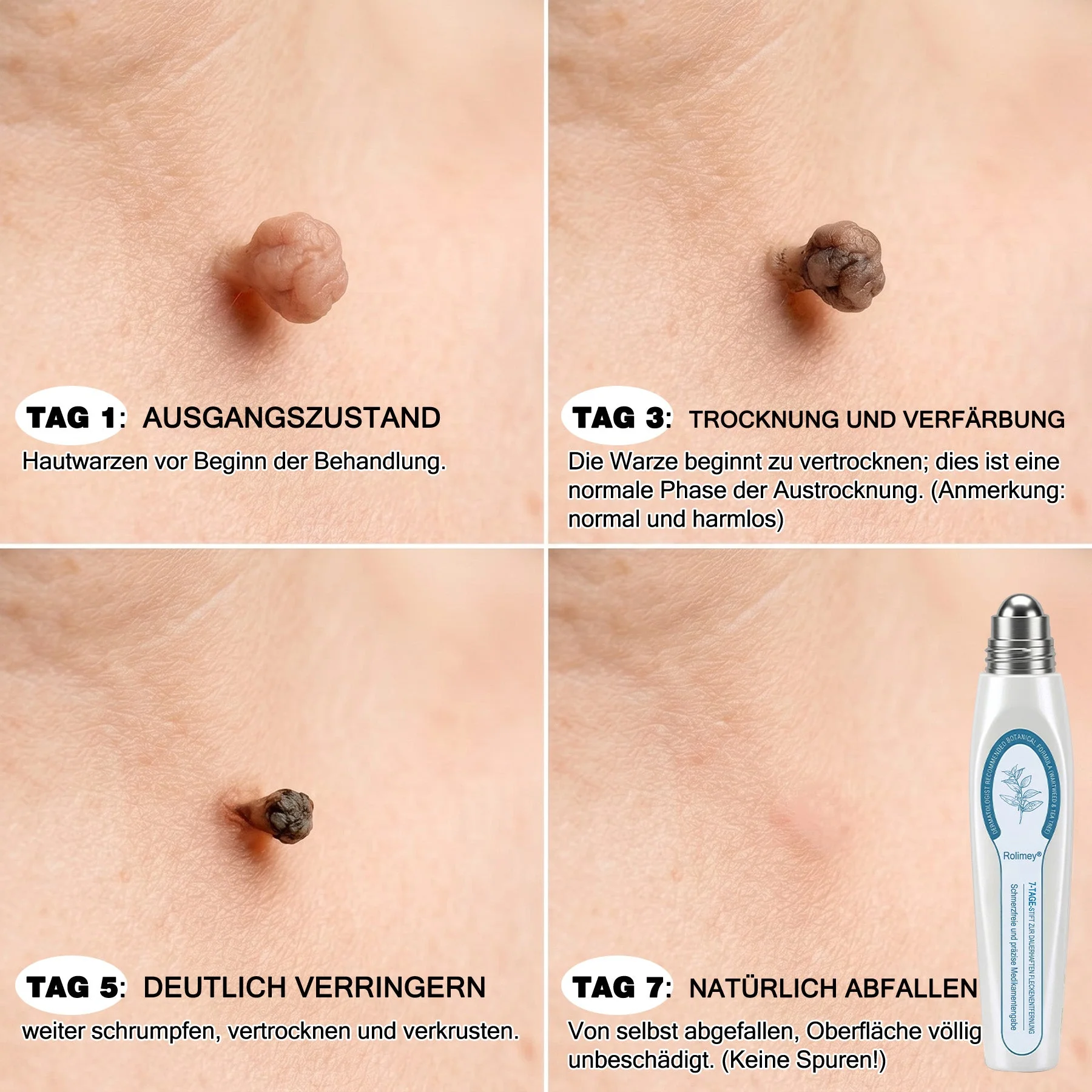 Rolimey® 7-Tage Tag- & Spot-Entferner🆕 (𝐙𝗲𝗿𝗼 𝐏𝗮𝗶𝗻, 𝐙𝗲𝗿𝗼 𝐒𝗰𝗮𝗿𝘀 Roll-On) ✅ Geeignet für: Hauttags, Flecken, Muttermale, Warzen, Blasen, Ekzeme, Schuppen, Hautkeratosen, Akne, Hautwucherungen, Narben, Geburtstagsmale 👩‍⚕️ - Image 3