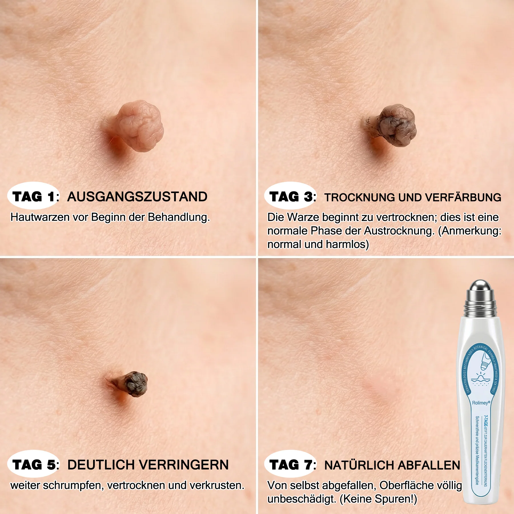Rolimey® 7-Tage Tag- & Spot-Entferner🤍 (𝐙𝗲𝗿𝗼 𝐏𝗮𝗶𝗻, 𝐙𝗲𝗿𝗼 𝐒𝗰𝗮𝗿𝘀 Roll-On) ✅ Geeignet für: Hauttags, Flecken, Muttermale, Warzen, Blasen, Ekzeme, Schuppen, Hautkeratosen, Akne, Hautwucherungen, Narben, Geburtstagsmale 👩‍⚕️ - Image 3