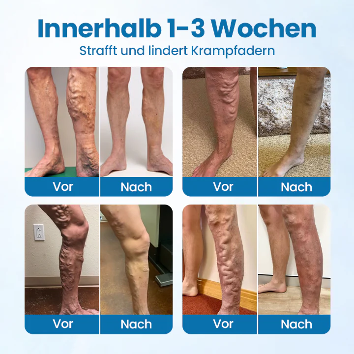 🔥🔥Ourlyard® VeinGuard Kräuterspray-✅Klinisch erwiesen, um Krampfadern in nur 7 Tagen zu beseitigen!! - Image 2