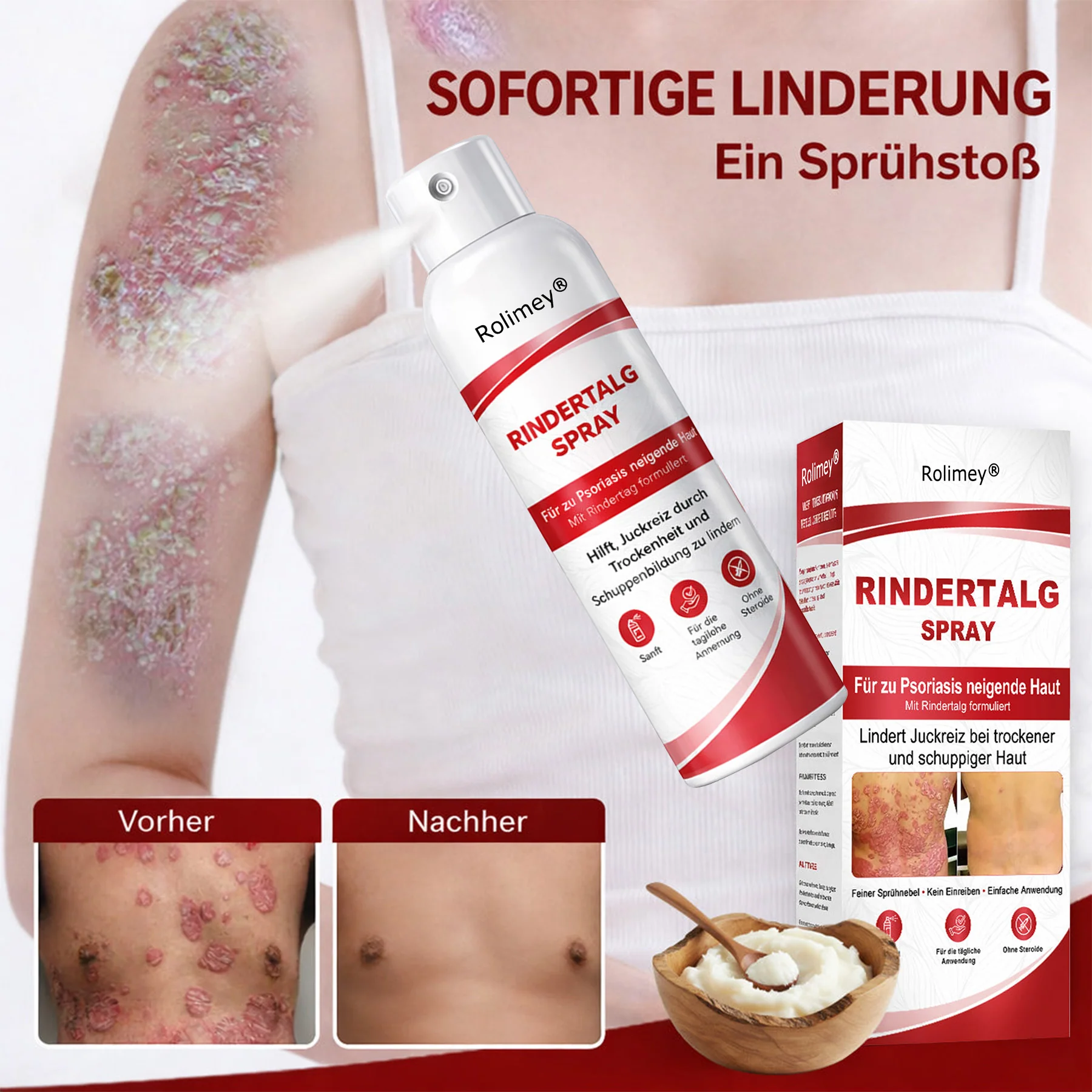 Rolimey® Rindertalg-Spray für juckende, schuppige Psoriasis-Haut 1 - Image 2