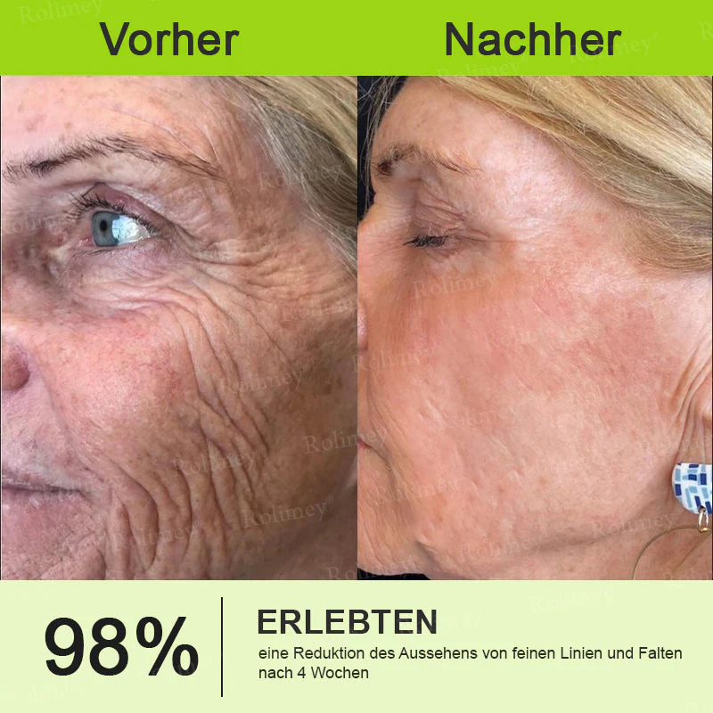 ✅Jetzt jugendliche Haut zurückgewinnen 💫Rolimey® Botox & Vita-A Retinol Shot Falten-Lift Straffungscreme - Image 12
